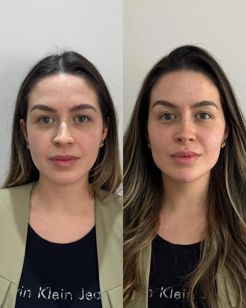 Resultado de Harmonização Facial