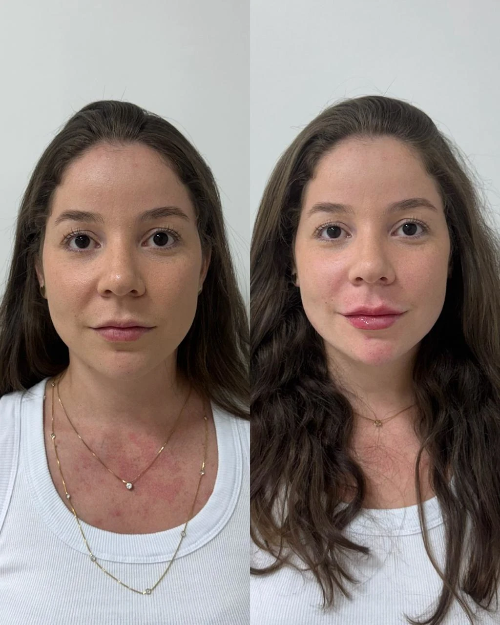 Resultado de Preenchimento Labial